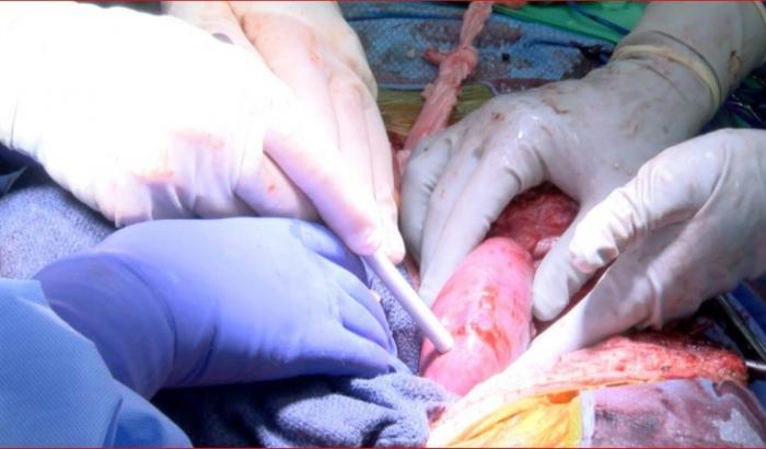 Photo fournie par l'Université d'Alabama montrant la transplantation d'un rein de porc sur un patient en état de mort cérébrale, le 30 septembre 2021