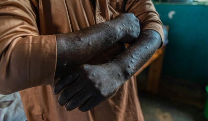 Un patient infecté par le mpox à Kamituga, le 20 septembre 2024 dans l'est de la RDC
