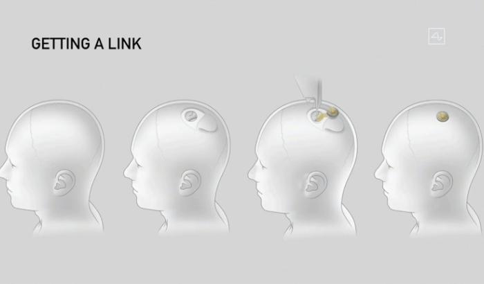 Image tirée d'une vidéo de diffusion en direct de Neuralink montrant un schéma des différentes étapes de l'implantation d'un dispositif Neuralink, lors d'une conférence le 28 août 2020 à San Francisco, en Californie