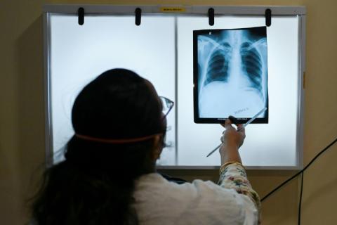 Derzeit in der Entwicklung befindliche neue Impfstoffe gegen Tuberkulose könnten nach Einschätzung der internationalen Impfallianz Gavi binnen weniger Jahre Millionen von Menschenleben retten.