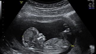 Ultraschall 12. Schwangerschaftswoche